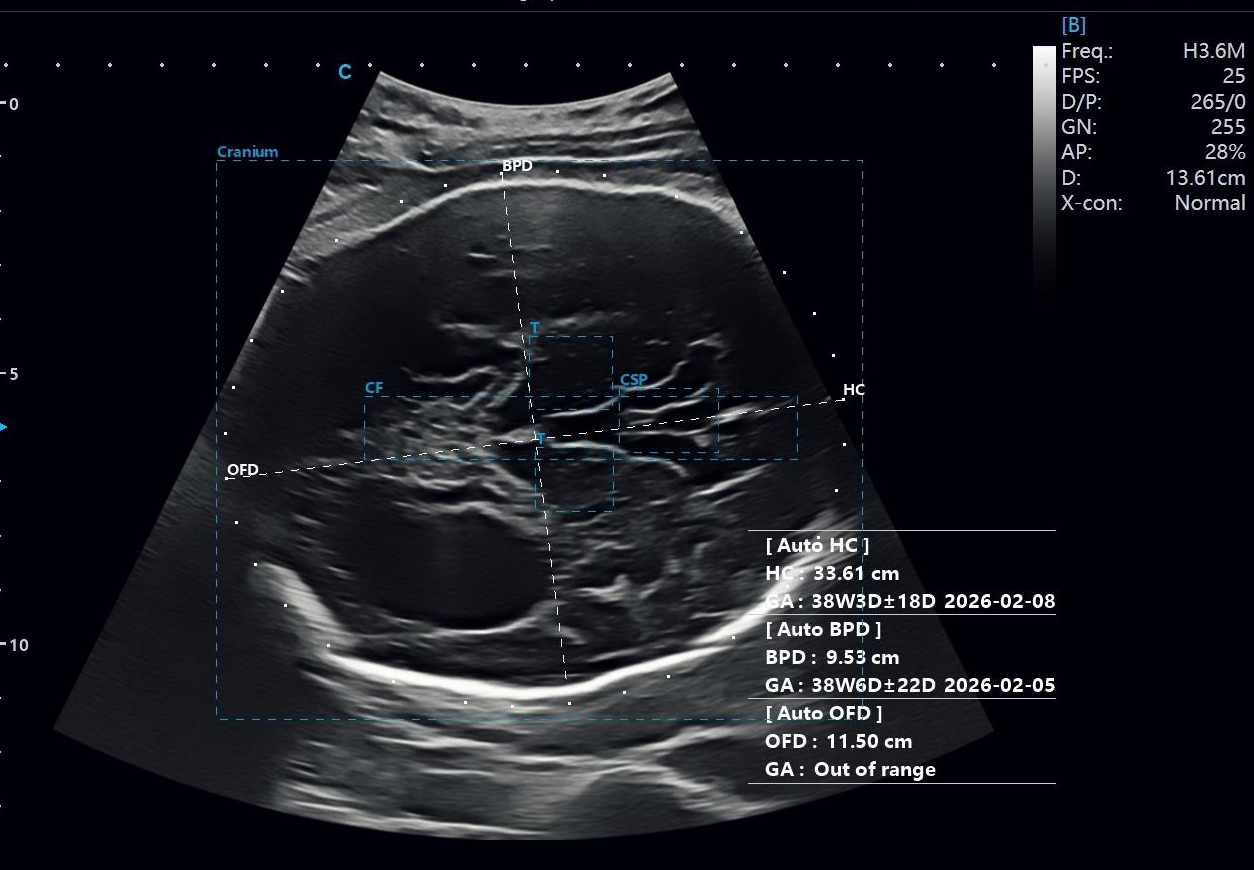 Fetal Lateral Ventricle Dilatation on Prenatal Ultrasound