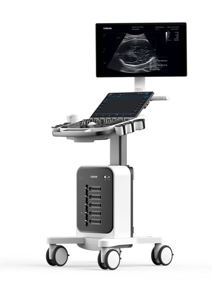 Fetal Lateral Ventricle Dilatation on Prenatal Ultrasound