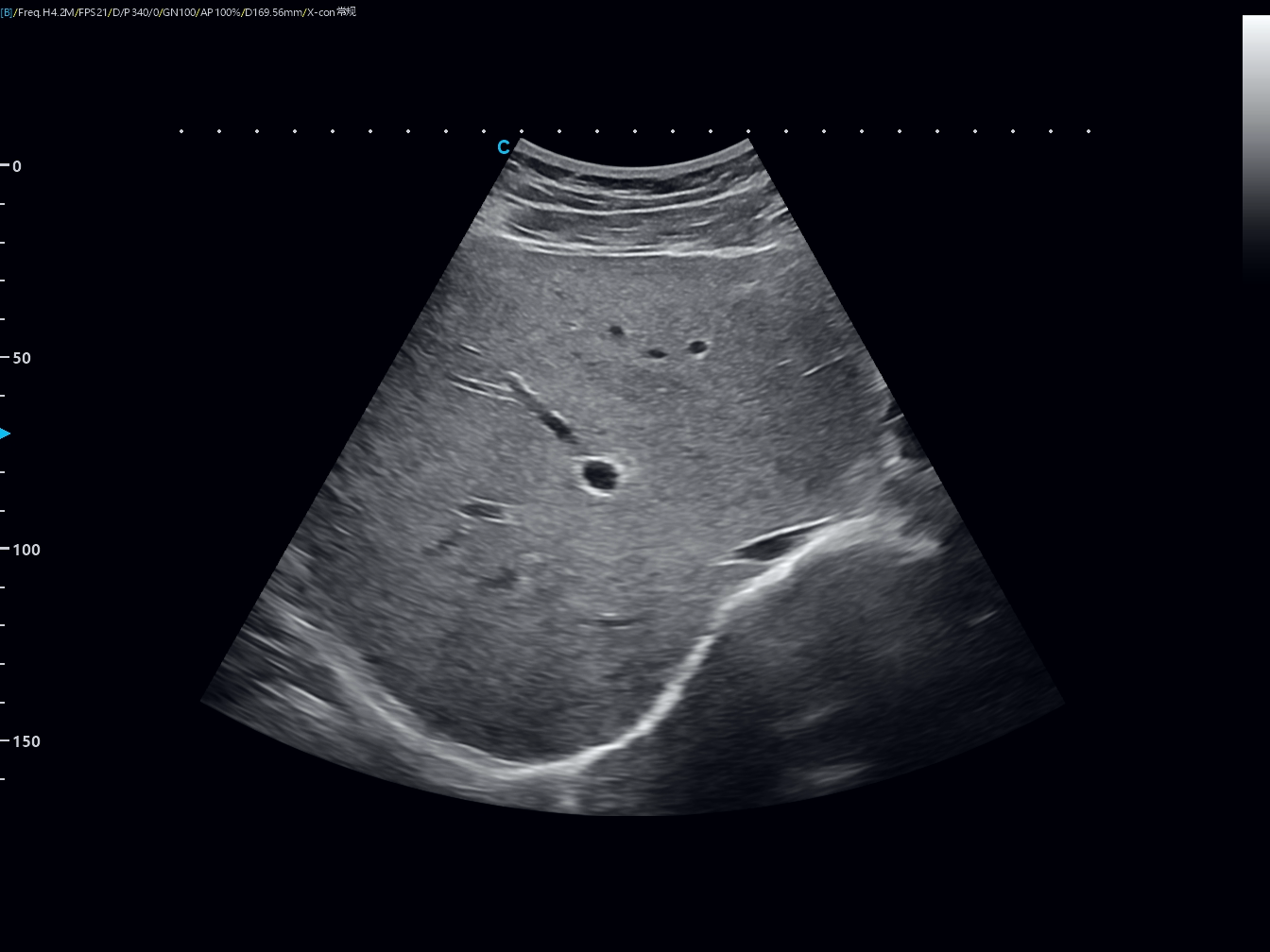 Liver Ultrasound: What It Shows, Benefits and Elastography