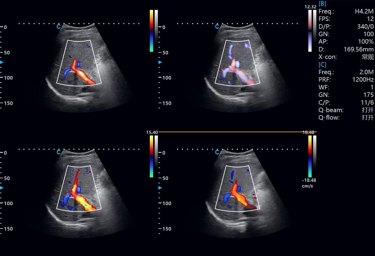Liver Ultrasound: What It Shows, Benefits and Elastography