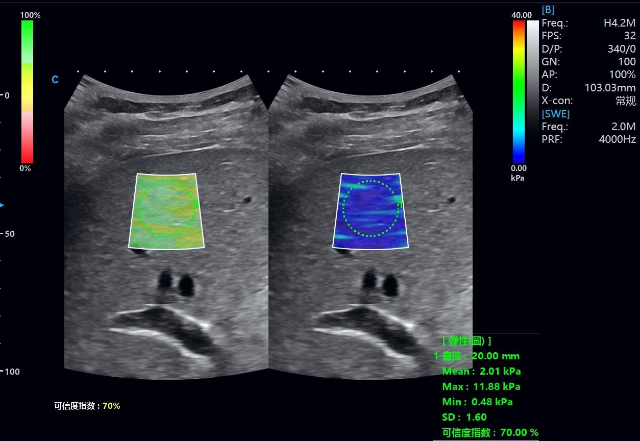 Liver Ultrasound: What It Shows, Benefits and Elastography