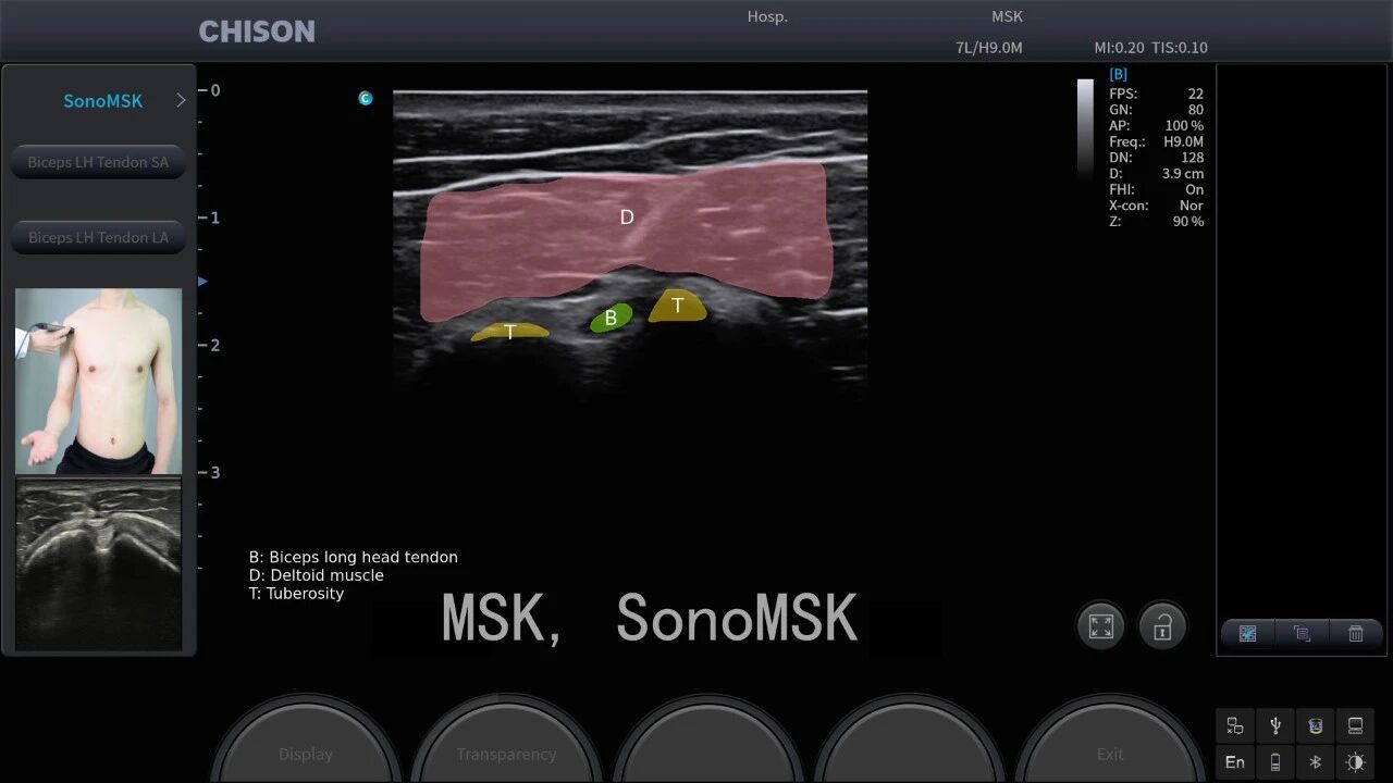 Humanitarian Aid | On the Front Line of Rehabilitation in Europe:Hercres and SonoAir Bring Portable Musculoskeletal Ultrasound Closer to Care