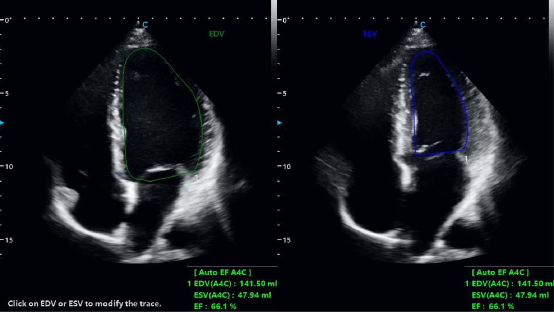 Humanitarian Aid | SonoMax Supports Cardiac Ultrasound in Spain