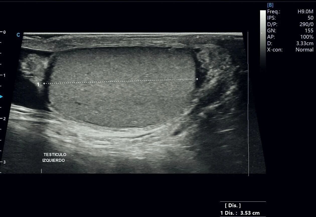 Testicular Hydrocele Ultrasound Case Study with SonoMax Testicular Hydrocele Ultrasound Case Study with SonoMax