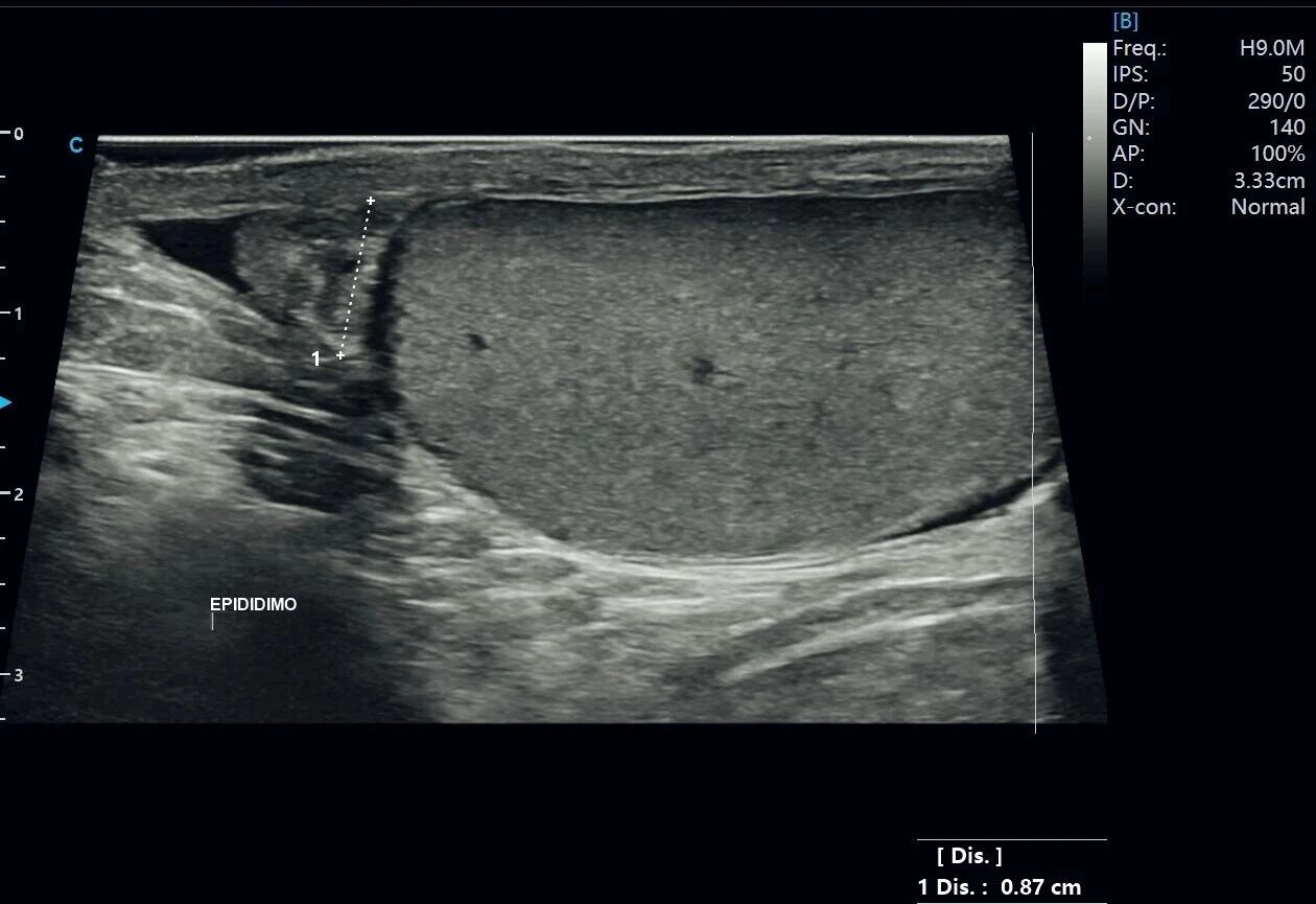 Testicular Hydrocele Ultrasound Case Study with SonoMax Testicular Hydrocele Ultrasound Case Study with SonoMax