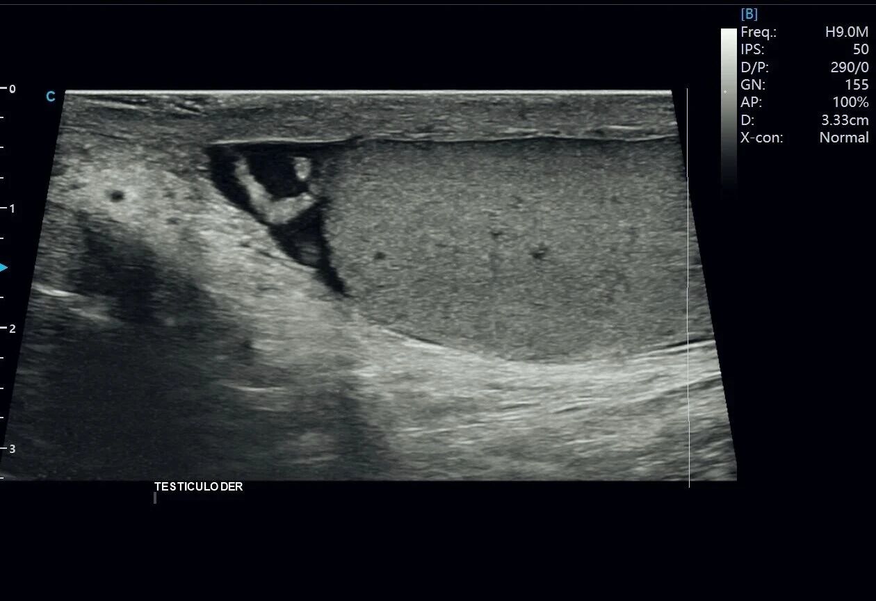 Testicular Hydrocele Ultrasound Case Study with SonoMax
