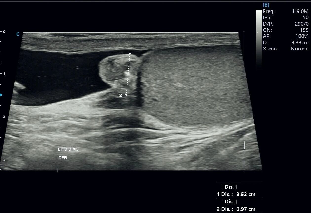 Testicular Hydrocele Ultrasound Case Study with SonoMax