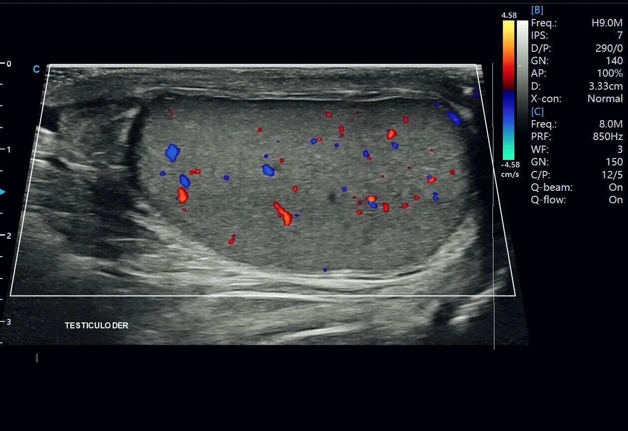Testicular Hydrocele Ultrasound Case Study with SonoMax Testicular Hydrocele Ultrasound Case Study with SonoMax