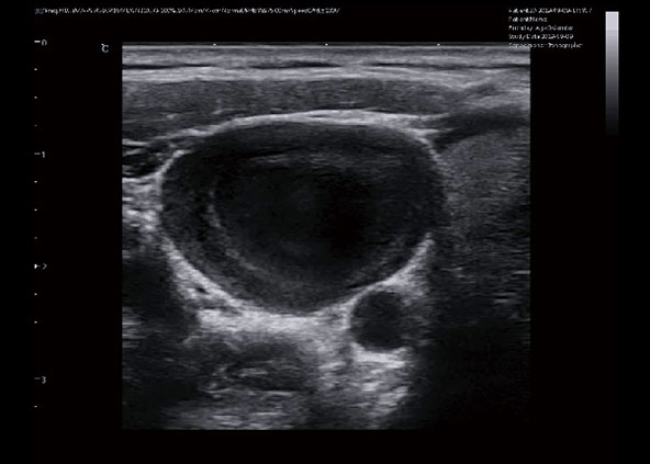 Jugular vein