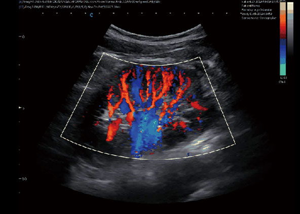 Kidney, C Mode