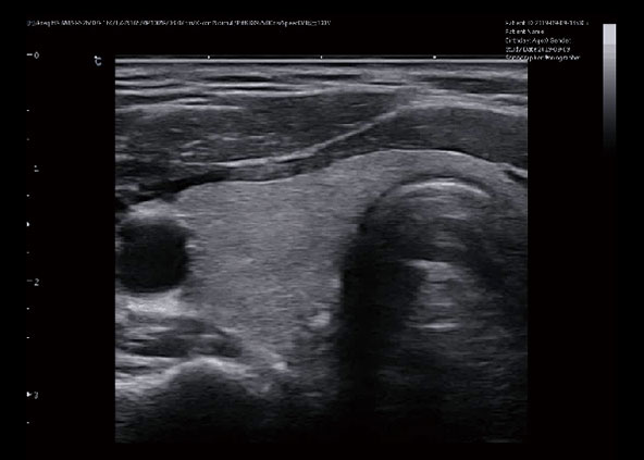 Thyroid, B mode