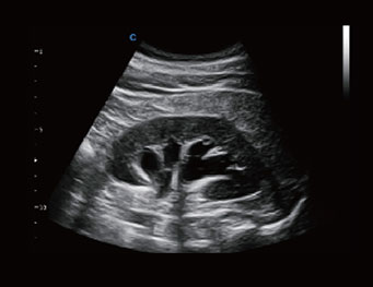 Hydronephrosis,B Mode