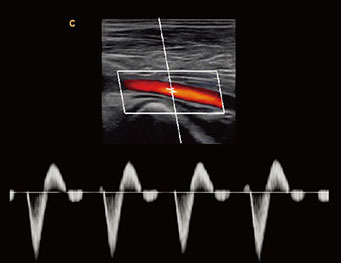 Femoral Artery, PW Mode