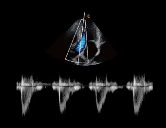 Aorta Valve,PW Mode