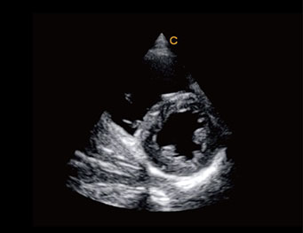 Papillary Muscles, TDI M Mode