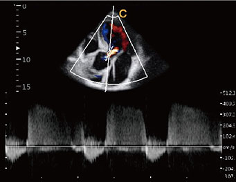 Aorta valve reguitation, CW Mode