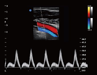 Popliteal Artery, Triplex Mode