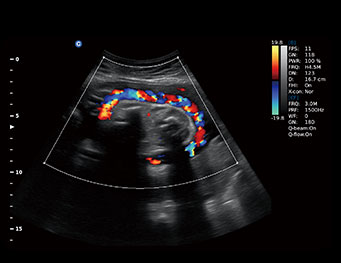 Umbilical cord, C Mode