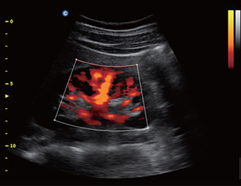 Kidney, CPA Mode