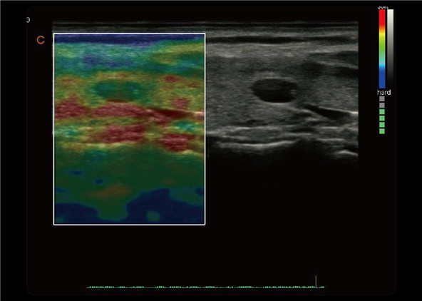 Quantitative Elastography