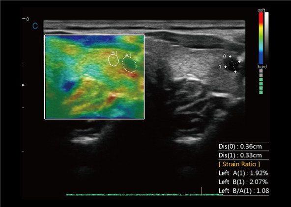 Quantitative Elastography