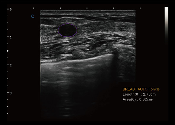 Auto Breast Detection