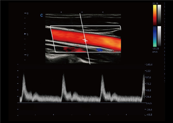 Intelligent Doppler