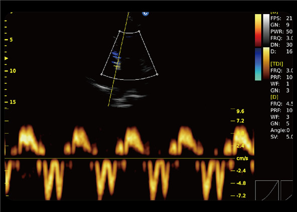 Tissue Doppler Imaging (TDI)