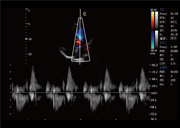 Continuous Wave (CW) Doppler