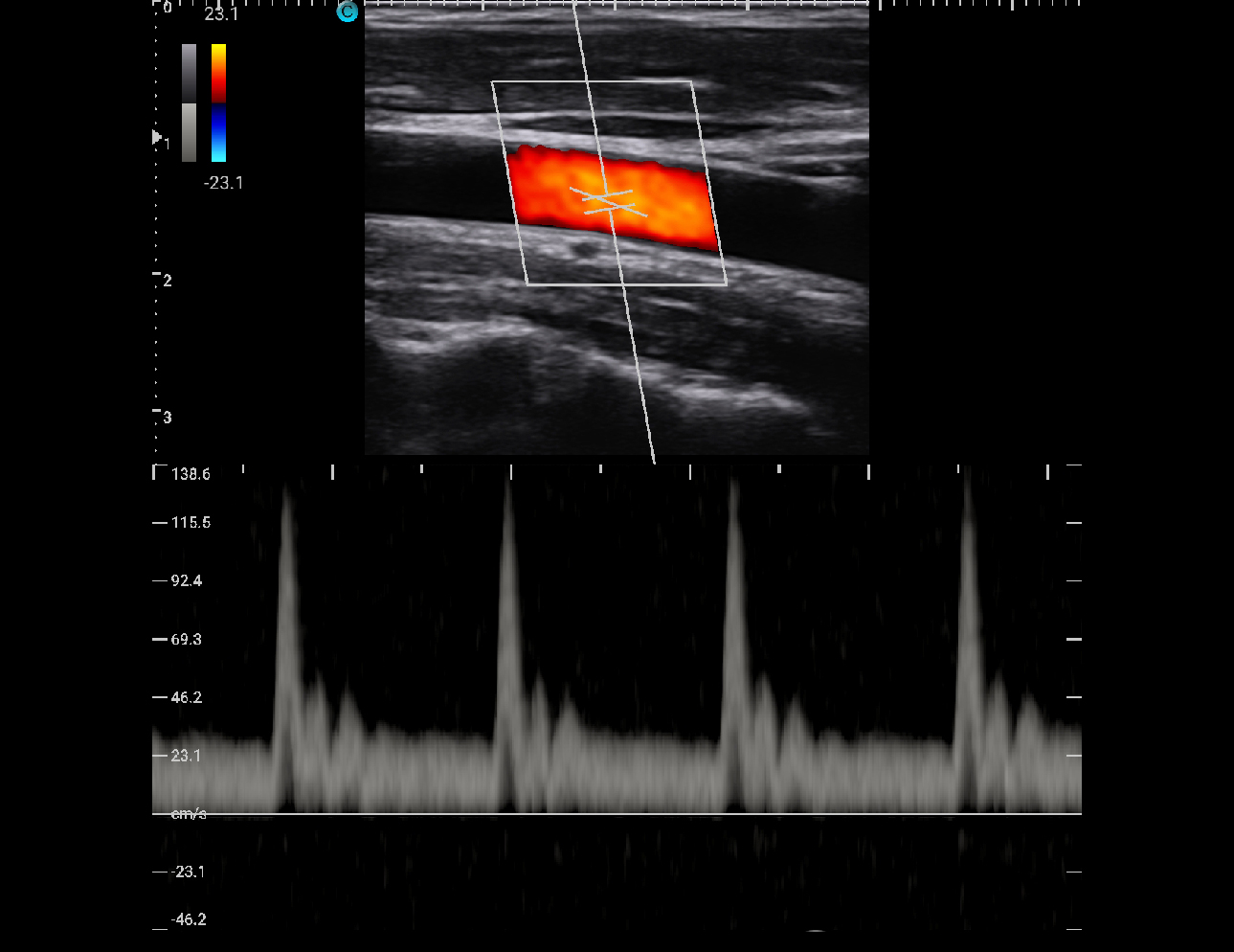 Carotid, PW Mode