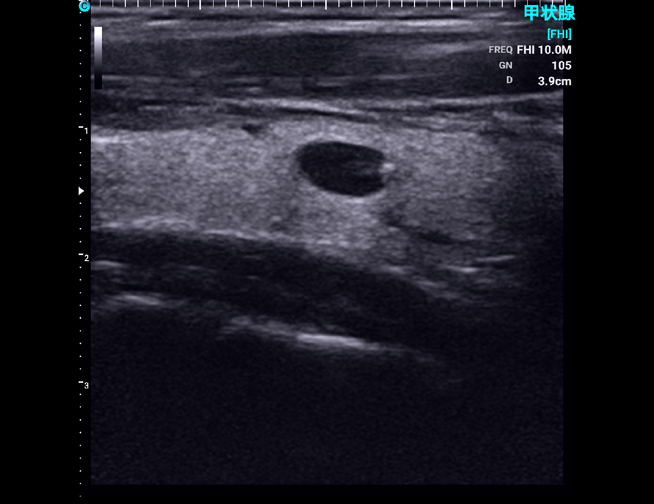 Thyroid, B Mode