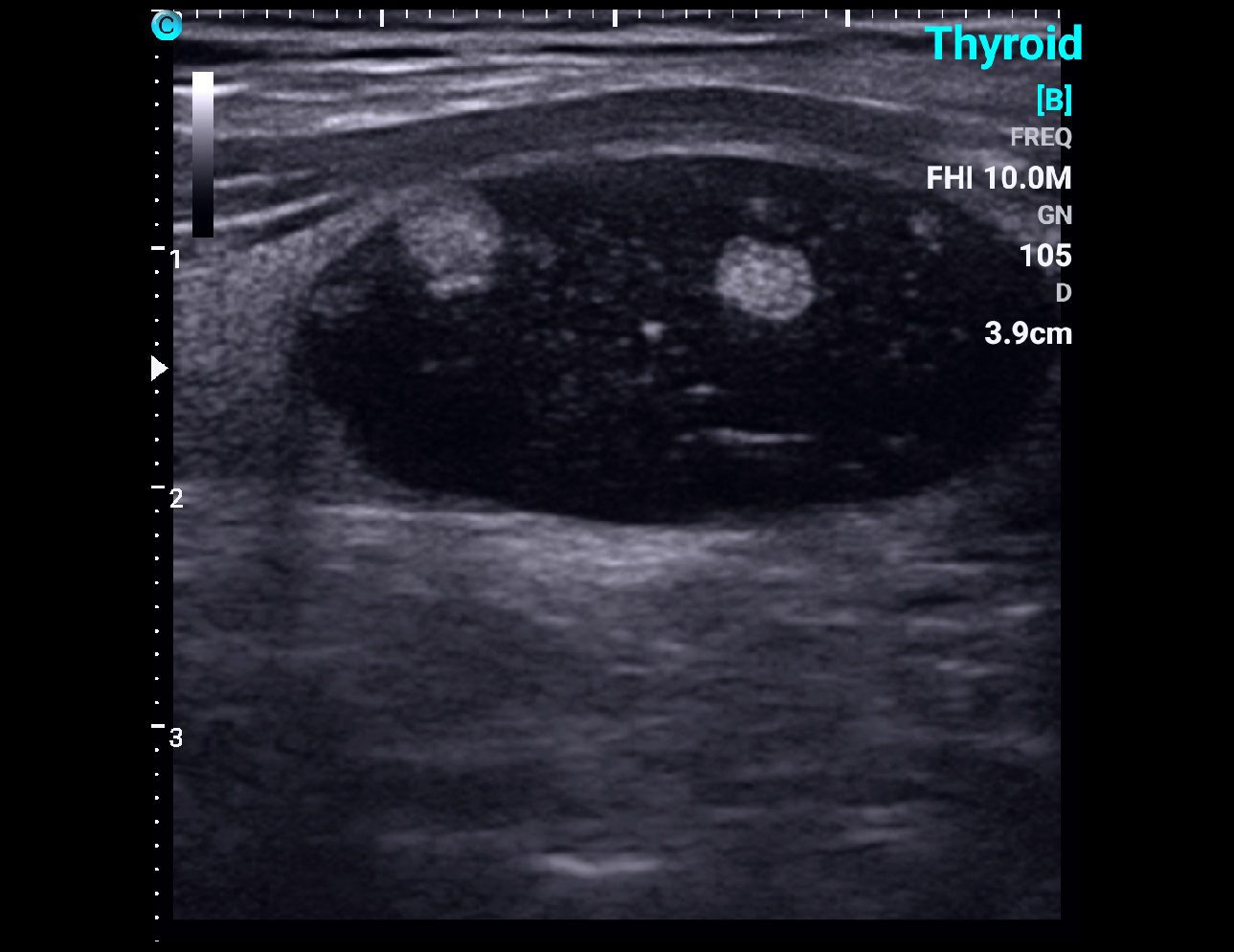 Thyroid, B Mode