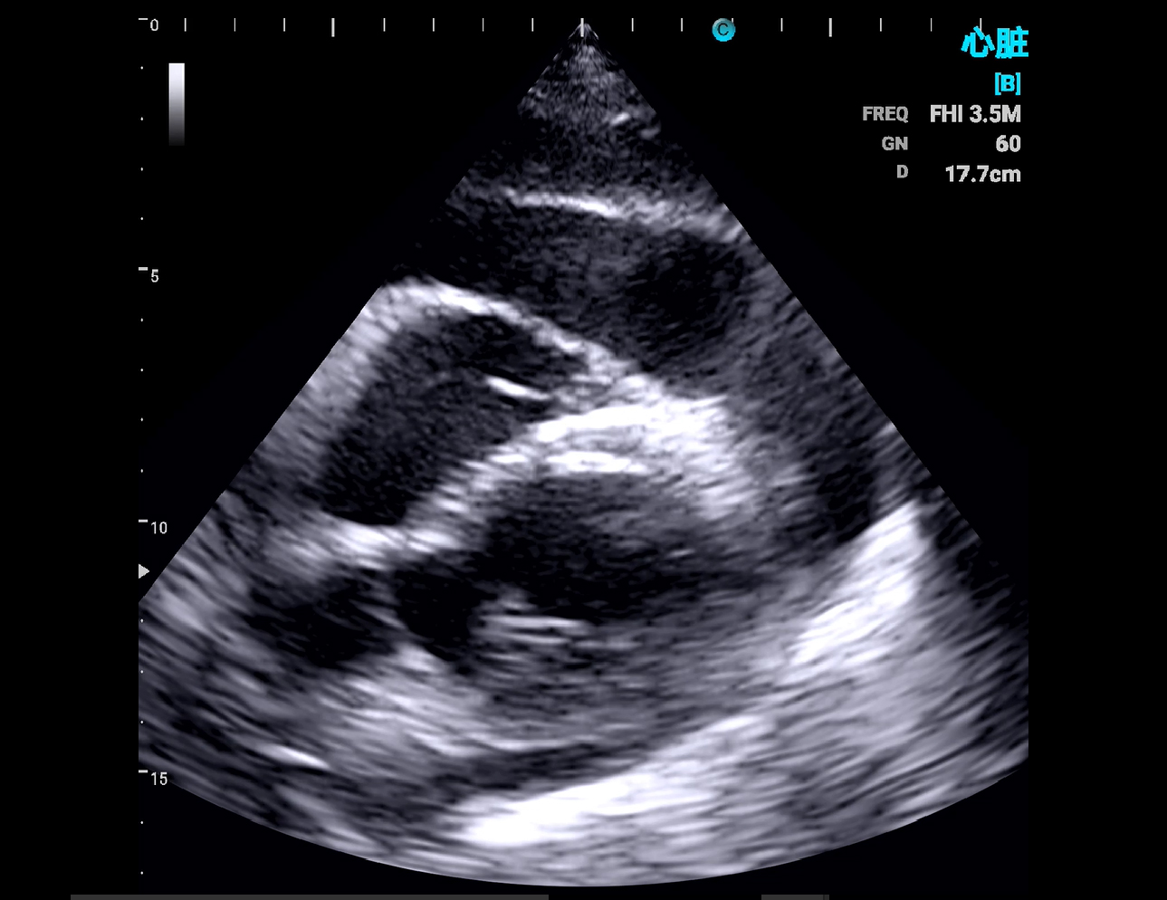 Cardiac, B Mode