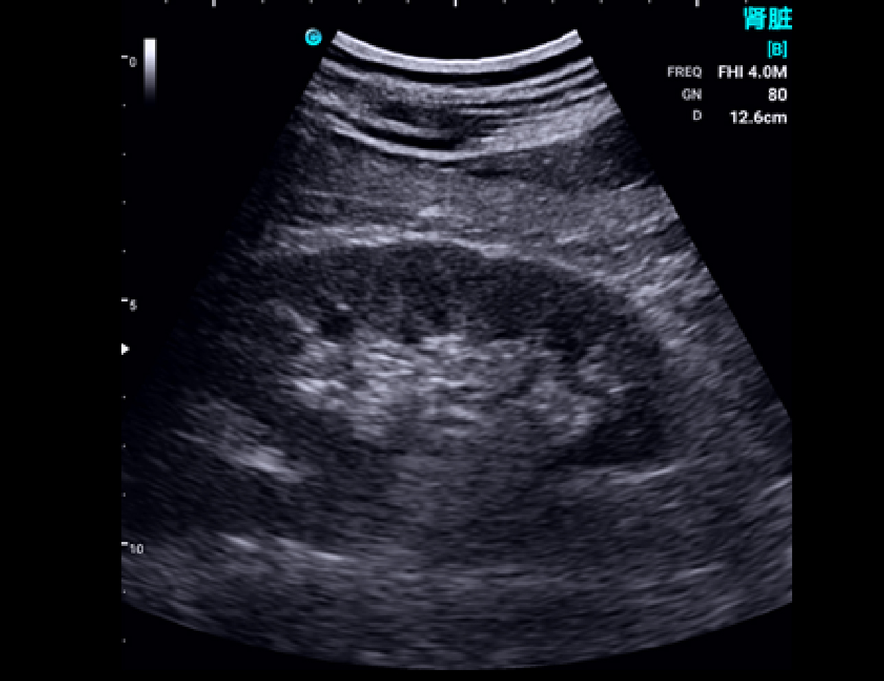 Kidney, B Mode