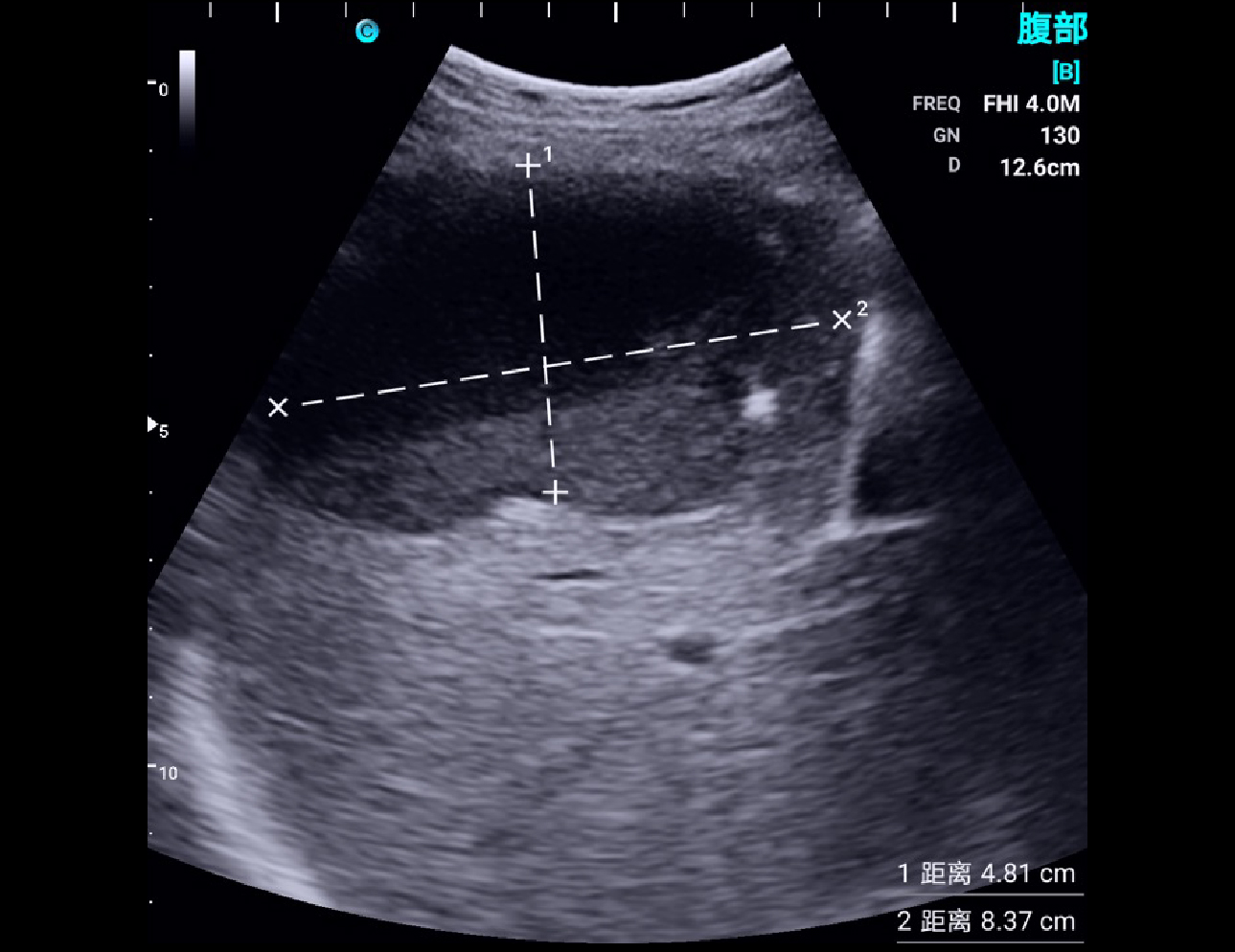 Liver Cyst, B Mode