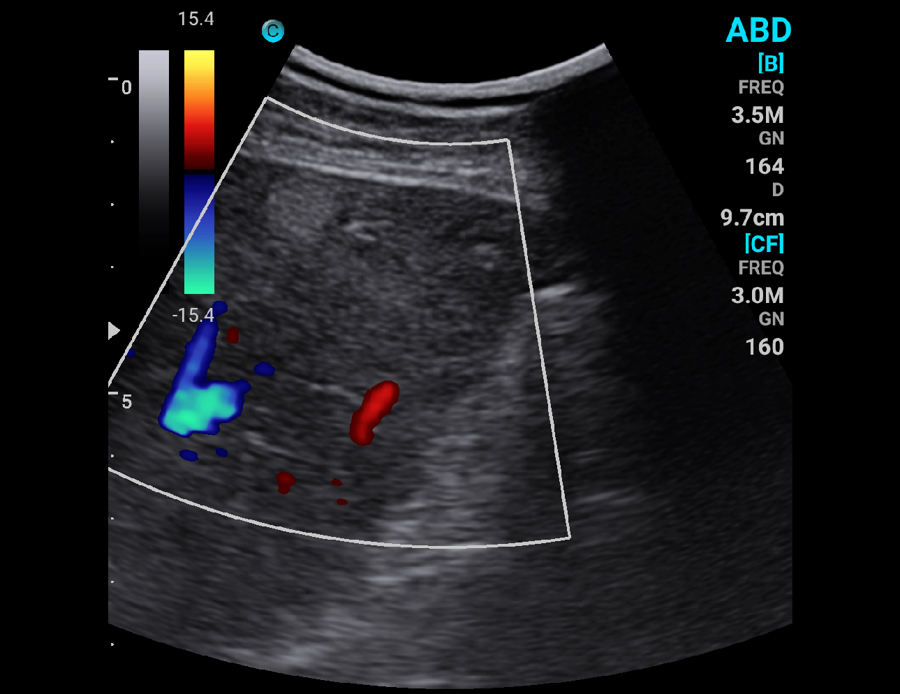 Hepatic Hemangioma, C Mode