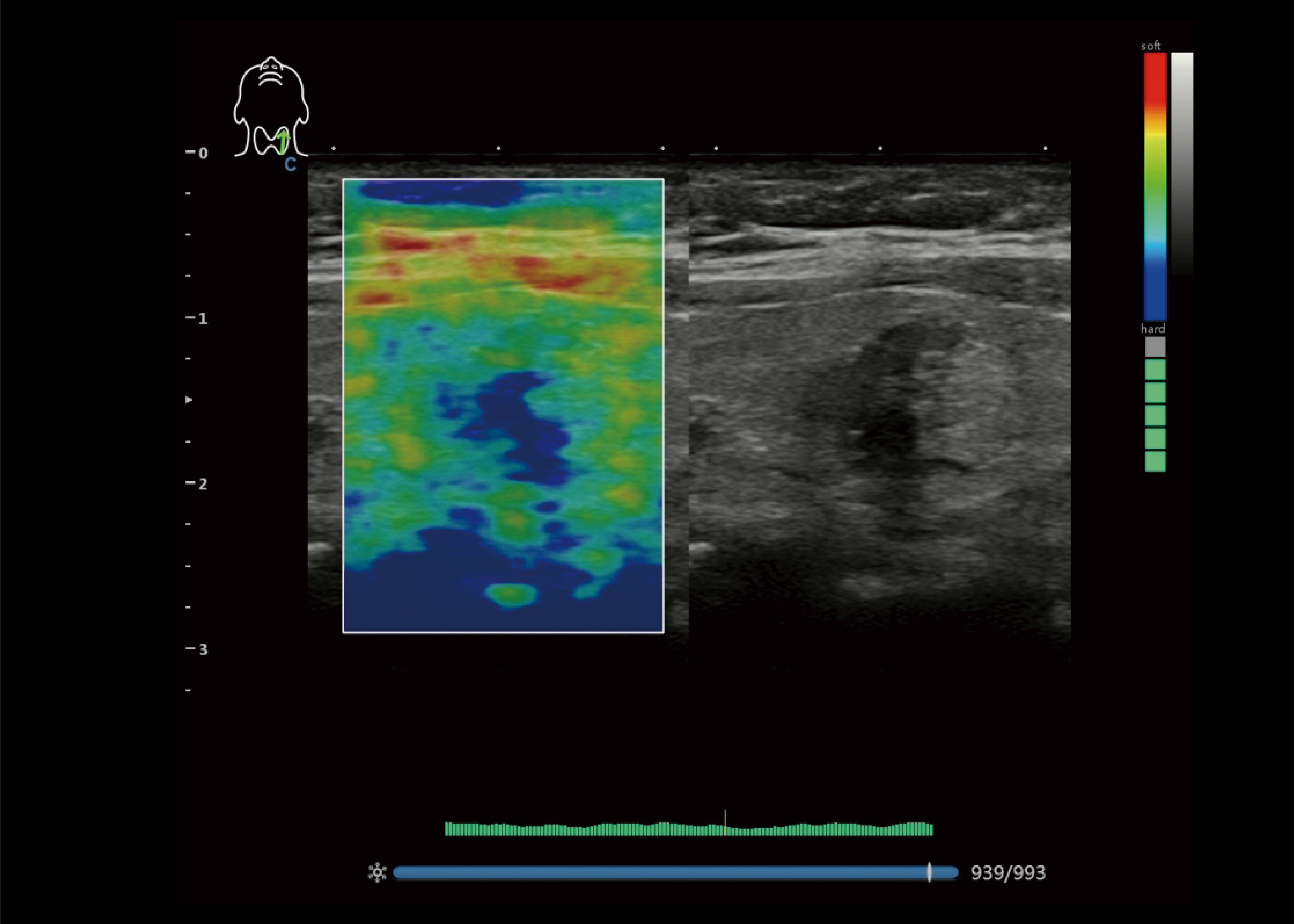 Elastography