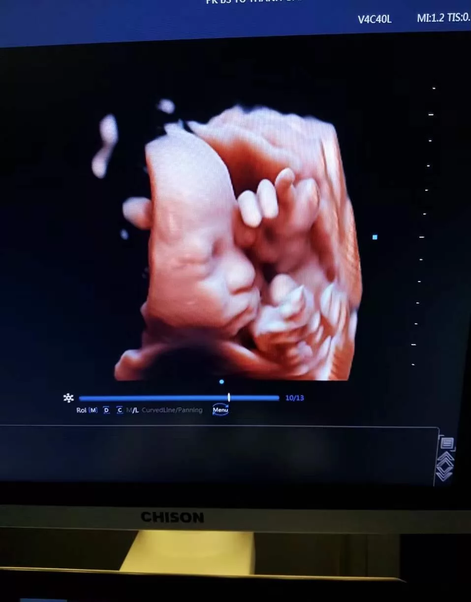 The 4D ultrasound machine provides images that are much clearer and more detailed than traditional 2D ultrasound scans, making it easier for doctors to identify potential health issues and plan for appropriate treatment.