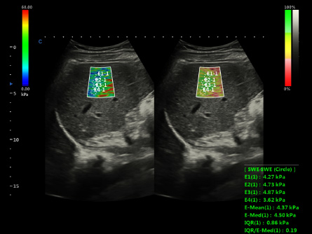 Shear Wave Elastography