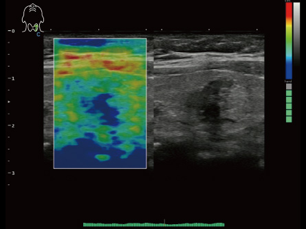 Elastography