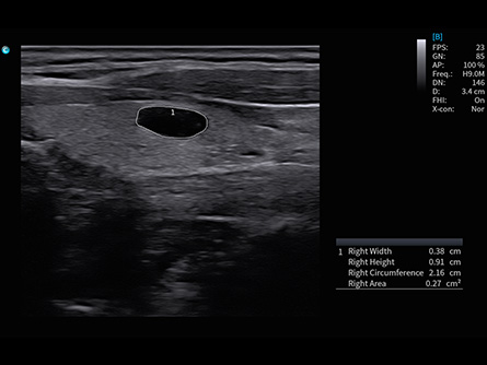 Auto Thyroid