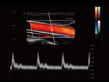 Intelligent Doppler