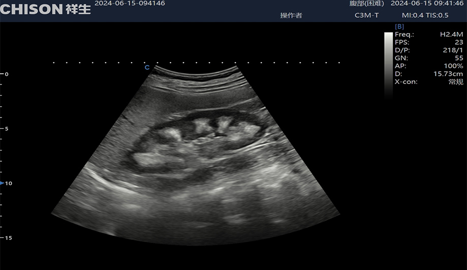 Ultrasound Diagnosis of Medullary Sponge Kidneys