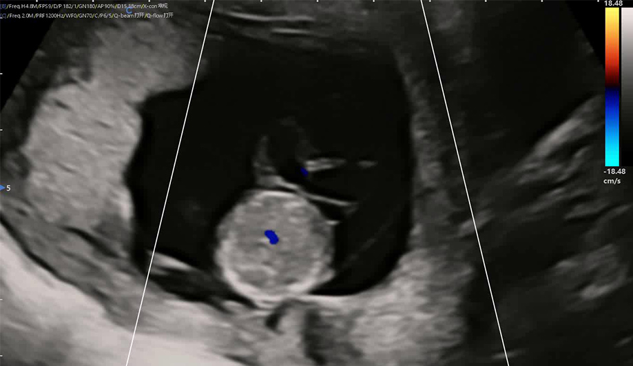 Ultrasound Diagnosis Of Fetal Umbilical Cord Cysts