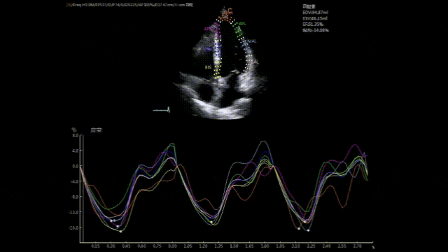 CHISON SonoAI: Smart Diagnosis, New Era