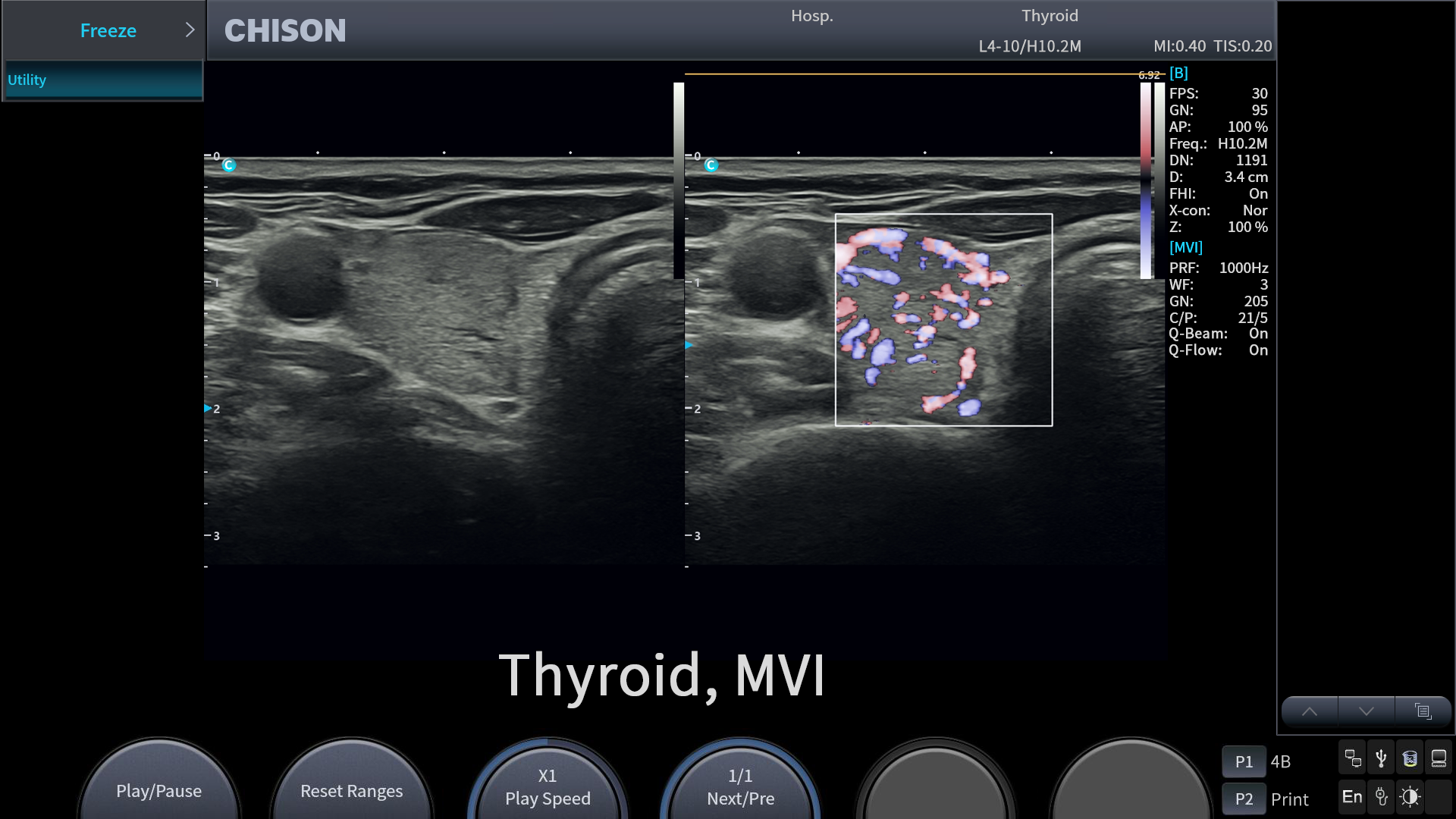 Thyroid,MVI