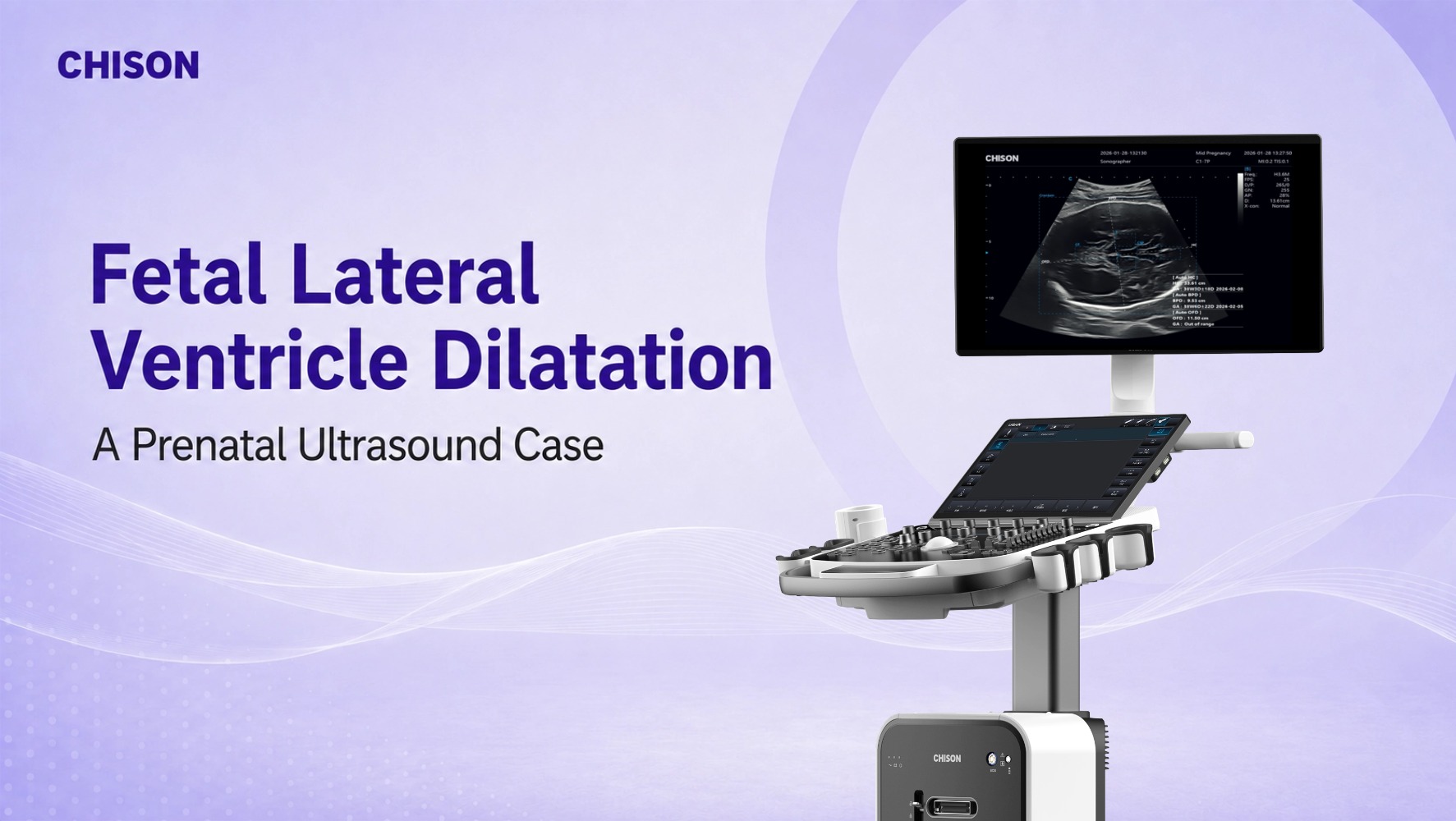 Fetal Lateral Ventricle Dilatation on Prenatal Ultrasound